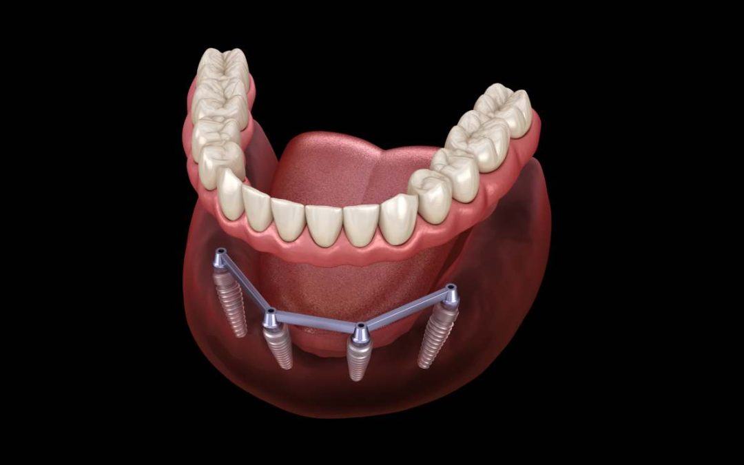 All-on-4 Dental Implants: A Complete Guide to Transformative Smiles
